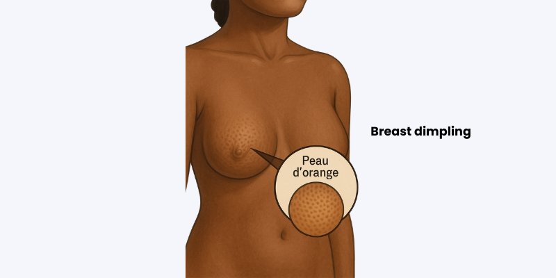 Early Signs of Breast Cancer