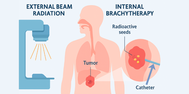 Infographic showing HDR, LDR, and electronic brachytherapy machine types.