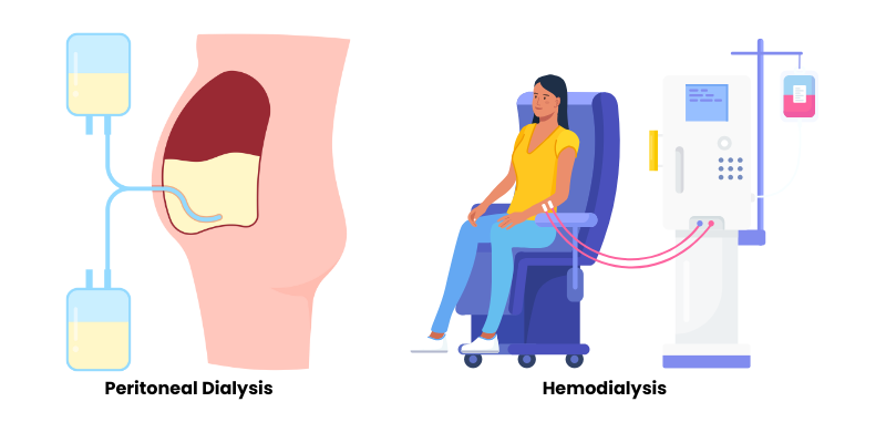 Comparison between hemodialysis and peritoneal dialysis techniques with labeled parts